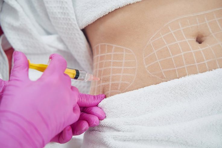 Mesoterapia Reductora